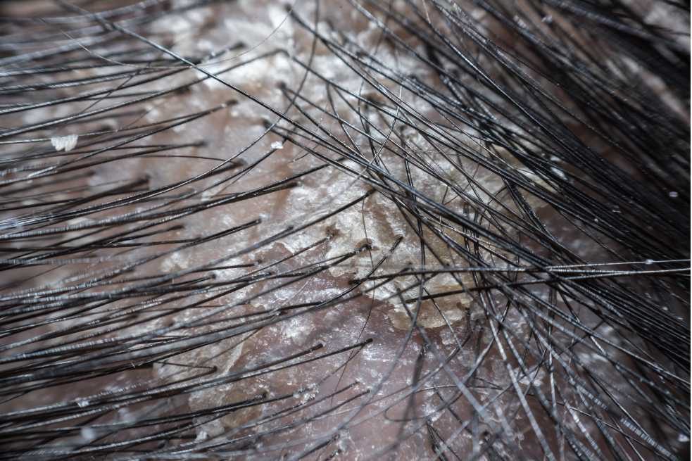 Can A Dry Scalp Cause Hair Loss? | Theradome