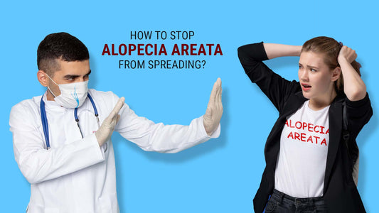 how to stop alopecia areata form spreading