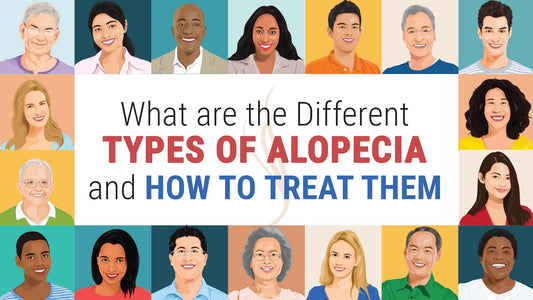 what are different types of alopecia and how to treat them