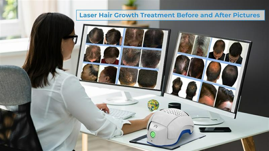 before and after pictures of laser hair growth treatments