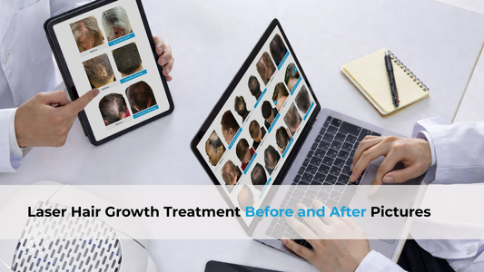 before and after pictures for laser hair growth treatment
