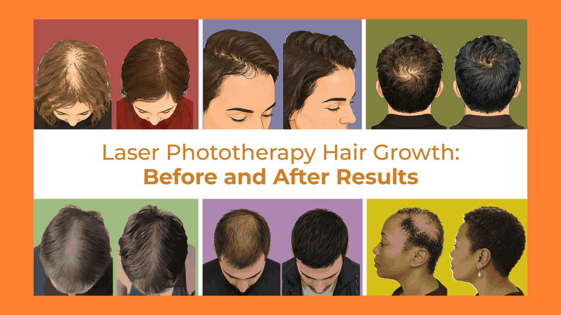 laser phototherapy hair growth before and after results