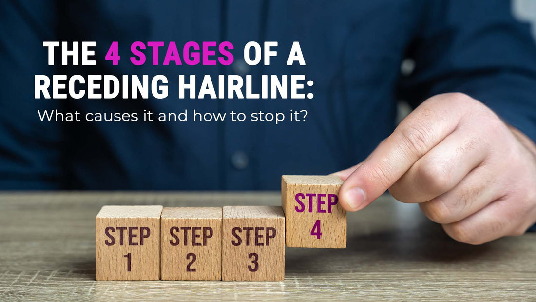 4 stages of receding hairline