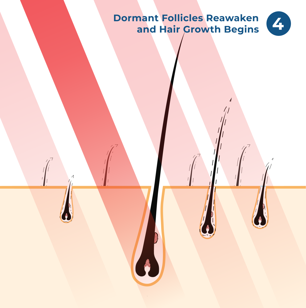 Step 4: Dormant Follicles Reawaken and Hair Growth Begins